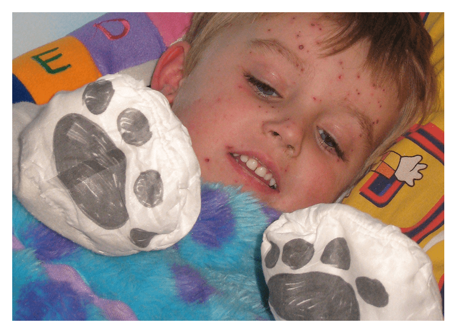Little boy with chicken pox wearing ScratchSleeves. Copyright Trolls and Tribulations Ltd, 2011