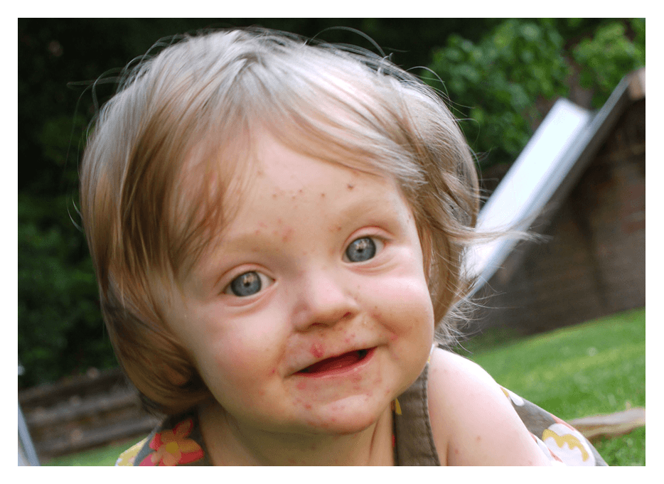 Little girl with chicken pox crawling towards camera. Copyright Trolls and Tribulations Ltd 2011