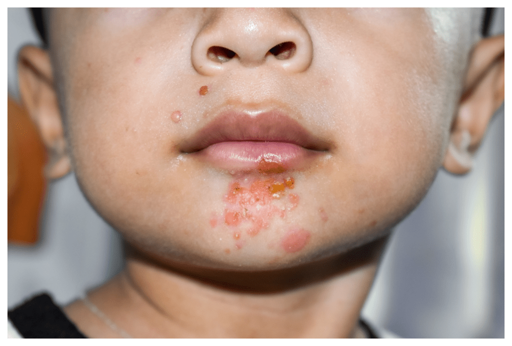 Photo of the bottom half of the face of an Asian boy with impetigo blisters around his mouth.