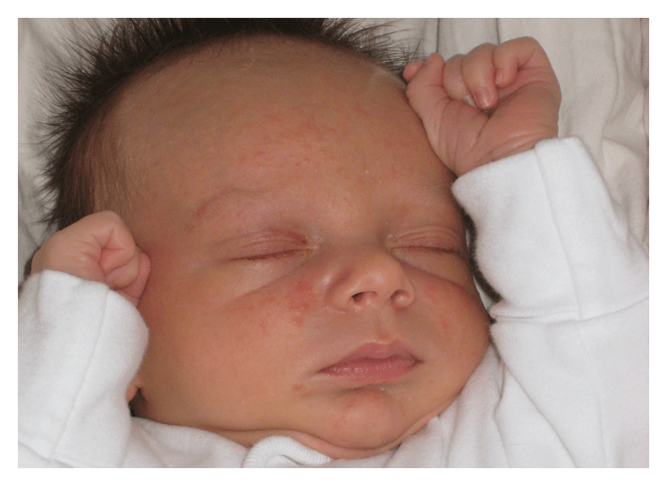 Headshot of 4 month old sleeping baby with inflamed red pimply eczema rash on his face and forehead. Copyright Trolls and Tribulations Ltd 2008