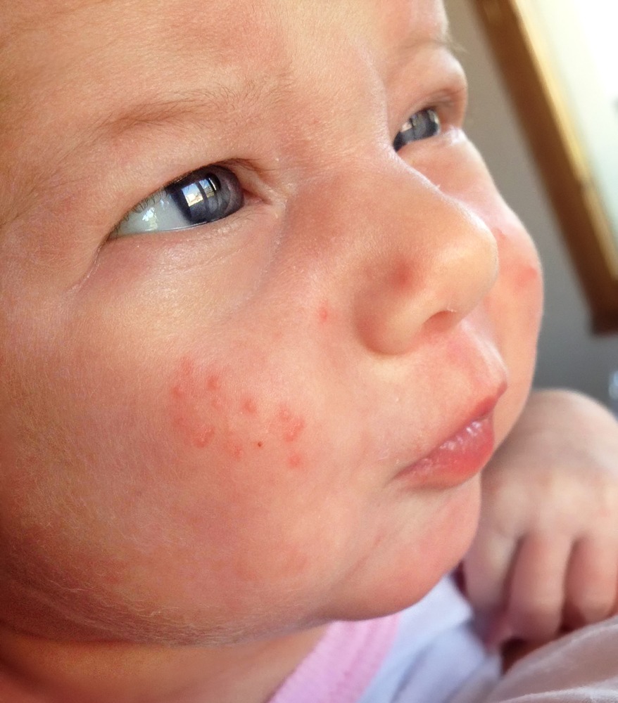 Caucasian baby with red baby acne spots clustered on her cheeks. The skin between the spots is clear.