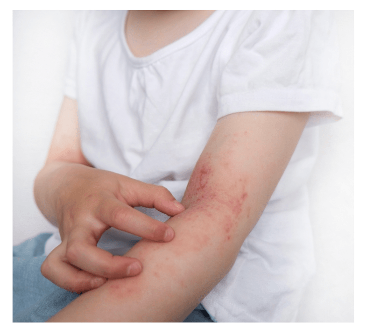 Child wearing white, short-sleeved t-shirt touching the angry red eczema on the inside of her elbows with her other hand. The eczema looks very sore and uncomfortable.