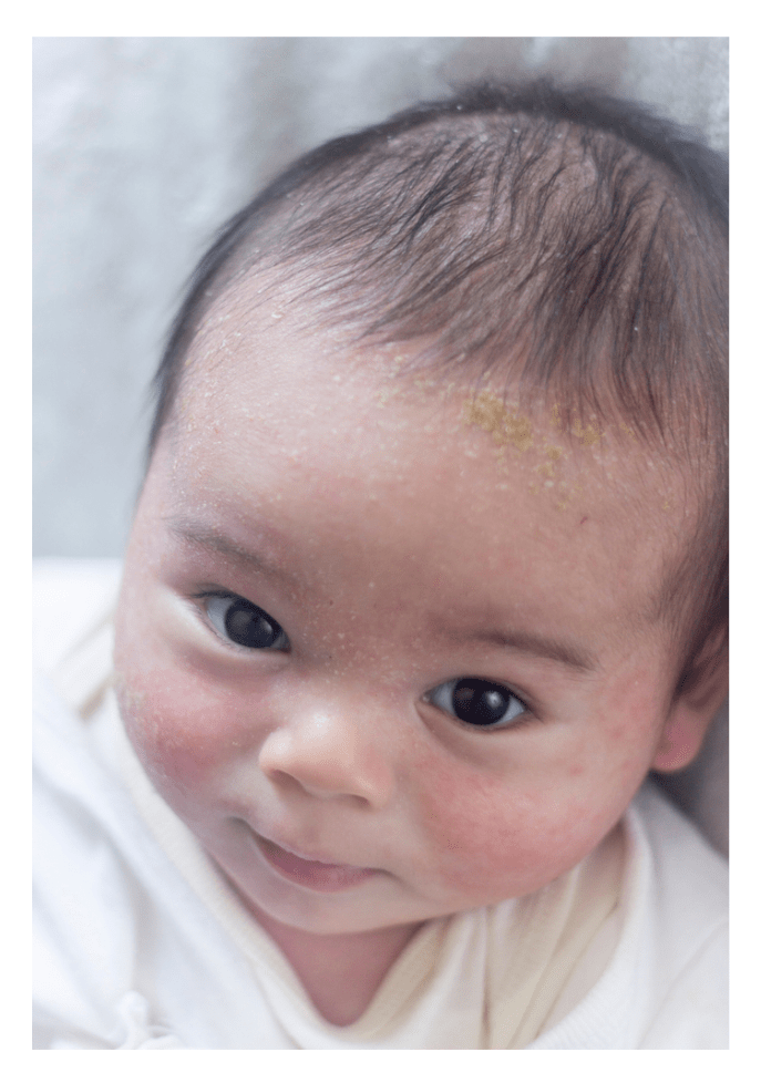 Asian baby with patches of yellow cradle cap (seborrheic dermatitis) around hair line