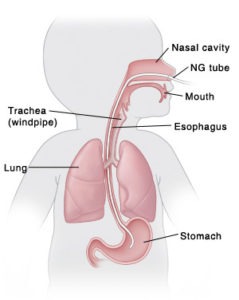 Cross-sectional diagram of how an NG feeding tube is inert through the nasah cavity, down the throat (avoiding the windpipe) and into the stomach.