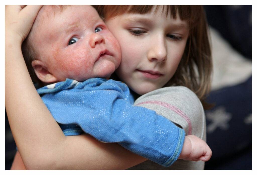 Young girl cuddles her baby brother, whose face is red and inflamed with baby eczema. He's looking up at the photographer for reassurance that he's not about to be dropped.