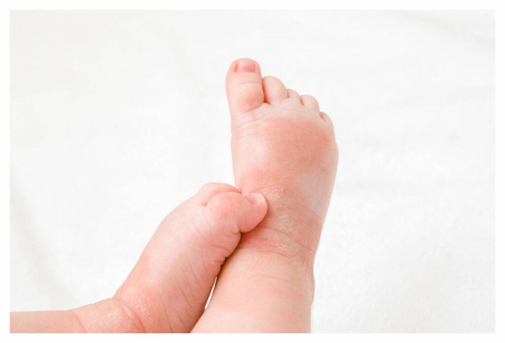 Close up of baby's legs and feet showing eczema patches and one foot scratching the other ankle.