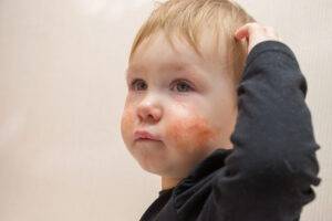 Little blonde boy with tears in his eyes and obviously infected eczema covering both cheeks. The eczema has a yellow crust and red, raw patches.