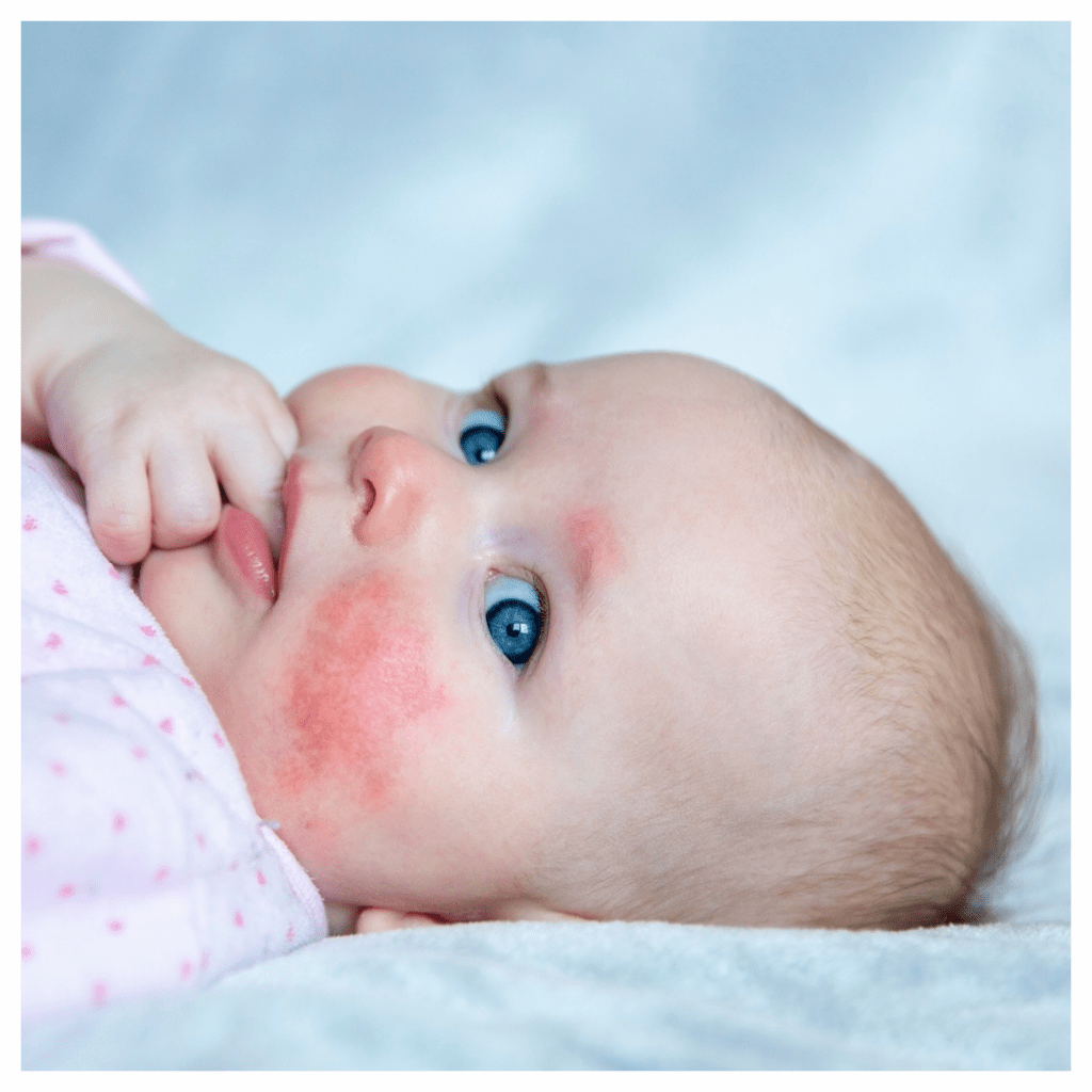 Baby girl sucking her finger with angry eczema on her cheeks and above her eyes. Treating this eczema early minimises the risk of food allergies later.