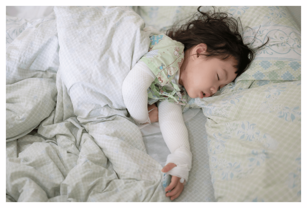 Sleeping girl wearing wet wrap bandages for eczema on her arms