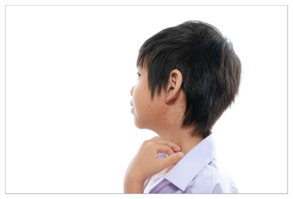 Young boy unconsciously scratching the eczema on his neck