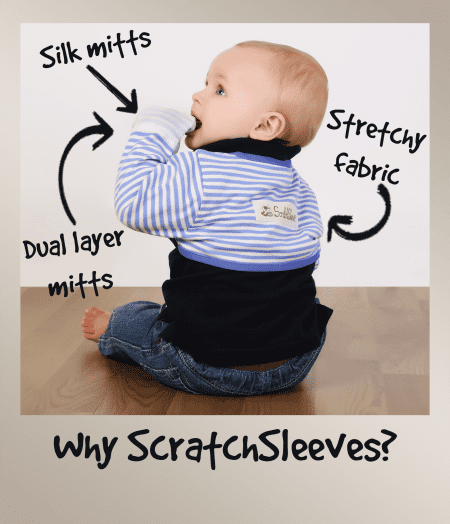 Toddler boy wearing blue and white ScratchSleeves scratch mittens, annotated to show how they work to reduce eczema scratching